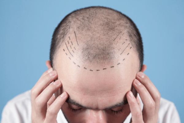 Tips To Treat Thinning Hair On Men