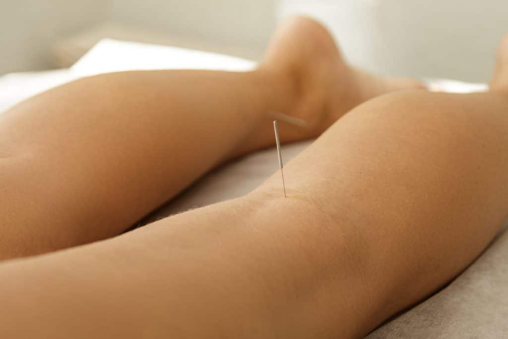 Female legs with steel needles during procedure of acupuncture therapy