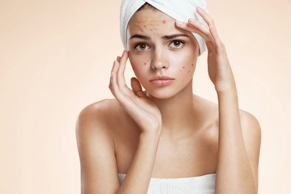 How To Get Rid Of Pimples
