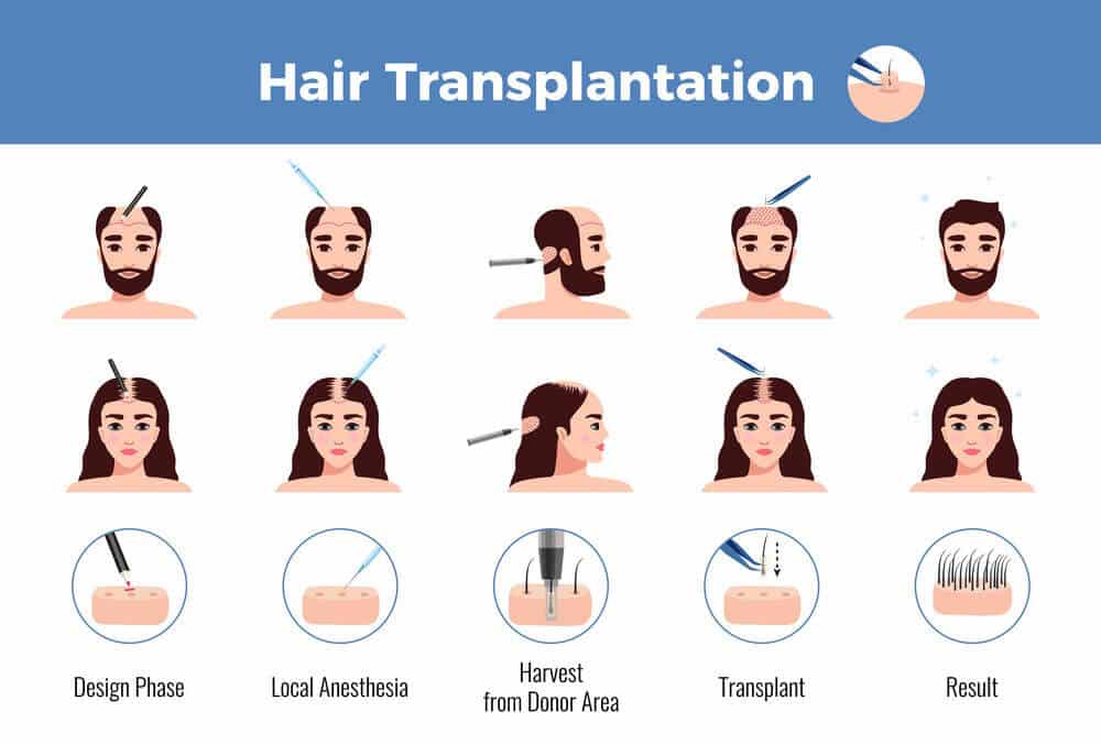 Hair Transplant Guide