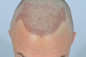 Hair Transplant Guide