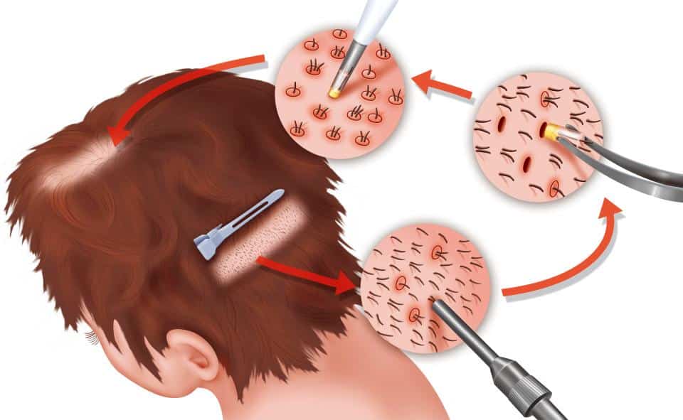 Hair Transplant Guide